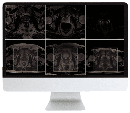 ARRS Pearls and Pitfalls in Prostate and Pelvic Imaging 2021 ARRS Pearls and Pitfalls in Prostate and Pelvic Imaging 2021