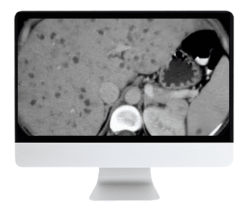 ARRS State of the Art Liver Imaging in Cirrhosis 2021 ( VIDEOS)