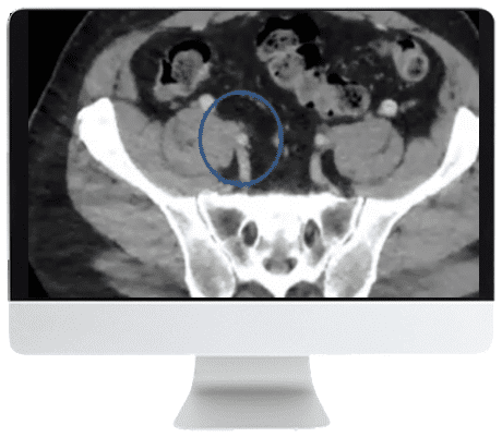 ARRS Venous Disease: Exploration of Advances, Challenges, and Future Directions 2021 (CME VIDEOS) ARRS Venous Disease: Exploration of Advances, Challenges, and Future Directions 2021 (CME VIDEOS)