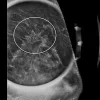 MRIOnline Imaging Mastery Series: High Risk Screening Breast MRI 2021