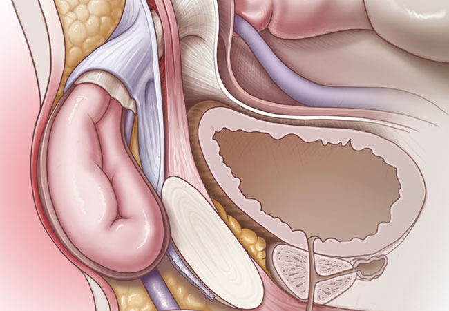 Cleveland Clinic Comprehensive Hernia Center 2019 Cleveland Clinic Comprehensive Hernia Center 2019