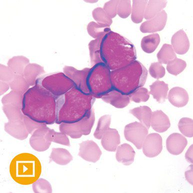 Current Concepts in Hematopathology 2022 ( VIDEOS) Current Concepts in Hematopathology 2022 ( VIDEOS)