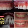 Esthetic and Functional Crown Lengthening Course Esthetic and Functional Crown Lengthening Course