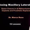 Missing Maxillary Lateral Incisors: Space Closure in all Malocclusions vs Implants and Prosthetic Replacement Missing Maxillary Lateral Incisors: Space Closure in all Malocclusions vs Implants and Prosthetic Replacement