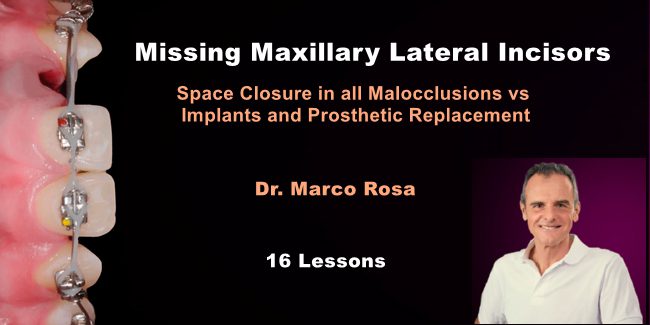 Missing Maxillary Lateral Incisors: Space Closure in all Malocclusions vs Implants and Prosthetic Replacement Missing Maxillary Lateral Incisors: Space Closure in all Malocclusions vs Implants and Prosthetic Replacement