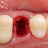 Gidedental Extraction Socket – Preservation/Grafting; Immediate vs Delayed Implants; Pontic Site Development 2020