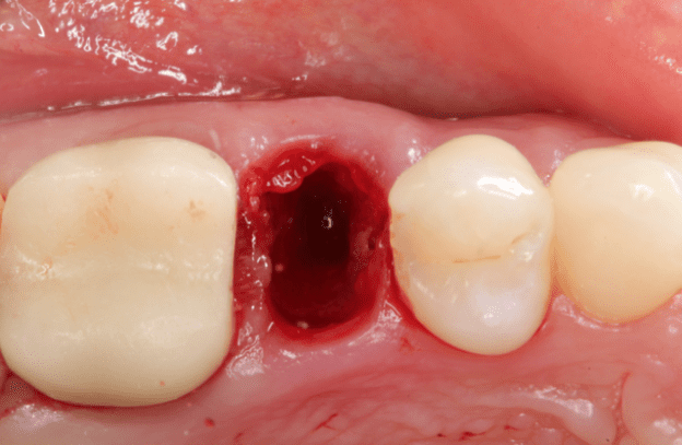 Gidedental Extraction Socket – Preservation/Grafting; Immediate vs Delayed Implants; Pontic Site Development 2020 Gidedental Extraction Socket – Preservation/Grafting; Immediate vs Delayed Implants; Pontic Site Development 2020