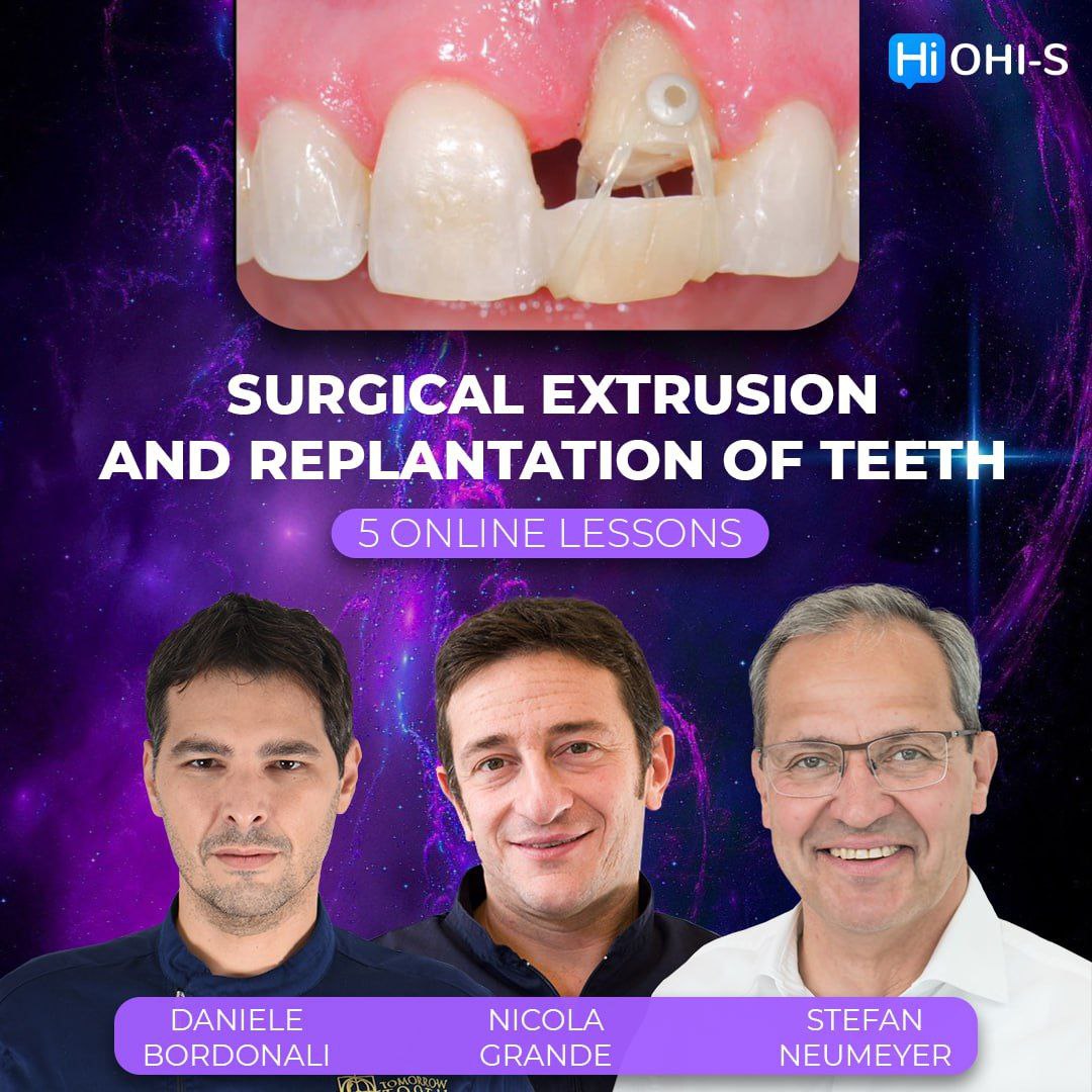 Surgical Extrusion and Replantation of Teeth Surgical Extrusion and Replantation of Teeth