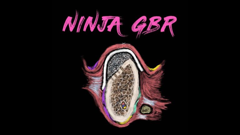Implant Ninja GBR – Guided Bone Regeneration Implant Ninja GBR – Guided Bone Regeneration
