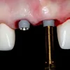 Gidental Online Residency Program: A-Z in Implant Dentistry Gidental Online Residency Program: A-Z in Implant Dentistry