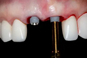 Gidental Online Residency Program: A-Z in Implant Dentistry Gidental Online Residency Program: A-Z in Implant Dentistry