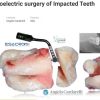 Piezoelectric Surgery of Impacted Teeth 2021 By: Angelo Cardarelli Piezoelectric Surgery of Impacted Teeth 2021 By: Angelo Cardarelli