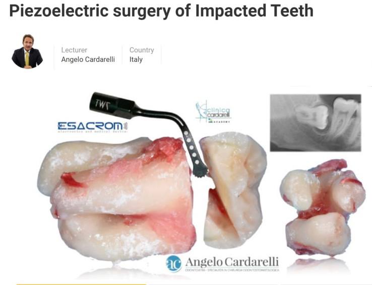 Piezoelectric Surgery of Impacted Teeth 2021 By: Angelo Cardarelli Piezoelectric Surgery of Impacted Teeth 2021 By: Angelo Cardarelli