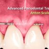 OHI-S Advanced Periodontal Treatment – Anton Sculean OHI-S Advanced Periodontal Treatment – Anton Sculean
