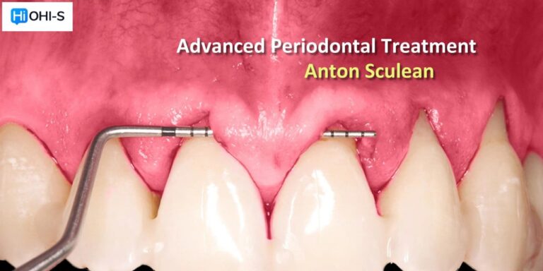 OHI-S Advanced Periodontal Treatment – Anton Sculean OHI-S Advanced Periodontal Treatment – Anton Sculean