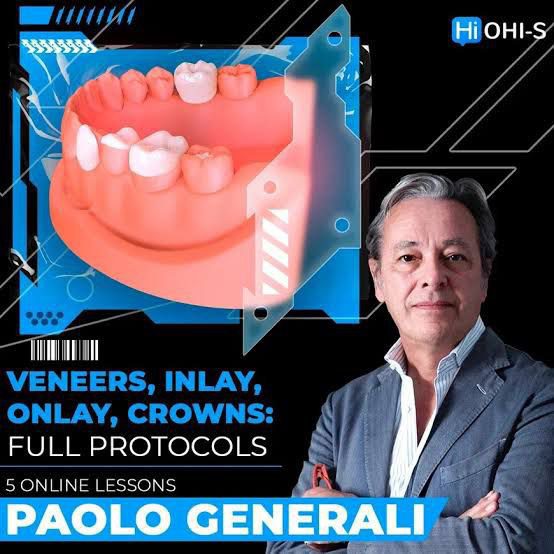 OHI-S Veneers, inlay, onlay, crowns: full protocols OHI-S Veneers, inlay, onlay, crowns: full protocols