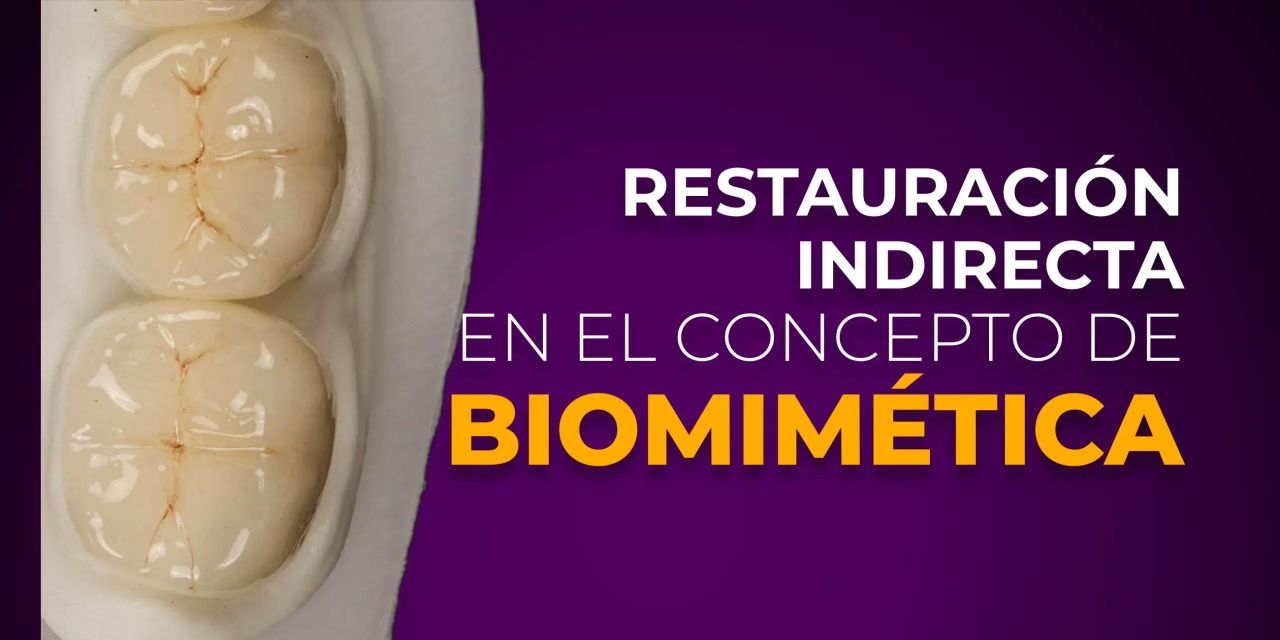 OHI-S Restauración indirecta en el concepto de biomimética Spanish OHI-S Restauración indirecta en el concepto de biomimética Spanish