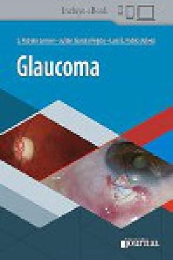 Glaucoma (Spanish Edition) (Original PDF from Publisher)
