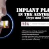 OHI-S Implant Placement in the Aesthetic Zone: Steps and Technique OHI-S Implant Placement in the Aesthetic Zone: Steps and Technique