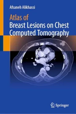 Atlas of Breast Lesions on Chest Computed Tomography (Original PDF from Publisher)