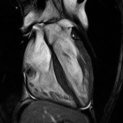 MRIOnline Mastery Series: Cardiac MRI of Non-Ischemic Cardiomyopathy 2021