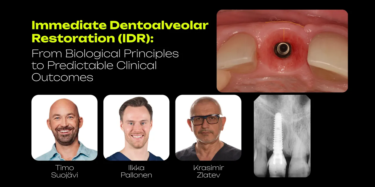 OHI-S Immediate Dentoalveolar Restoration (IDR) From Biological Principles to Predictable Clinical Outcomes 4 lessons 2h 43min OHI-S Immediate Dentoalveolar Restoration (IDR) From Biological Principles to Predictable Clinical Outcomes 4 lessons 2h 43min