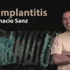 Osteocom Peri-implantitis by Ignacio Sanz