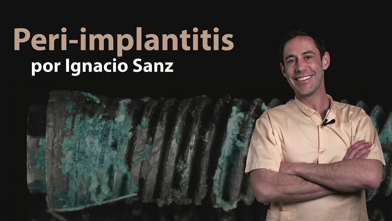 Osteocom Peri-implantitis by Ignacio Sanz Spanish Osteocom Peri-implantitis by Ignacio Sanz
